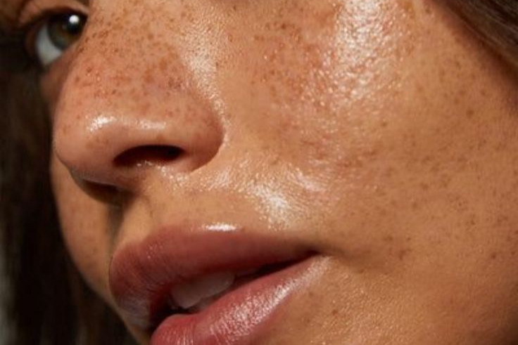 Piel opaca y poros marcados EMY MedSpa